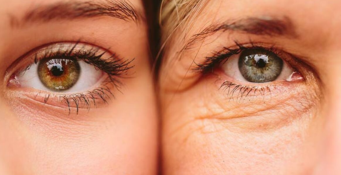Ydre tegn på ældning af huden omkring øjnene hos to kvinder i forskellige aldre