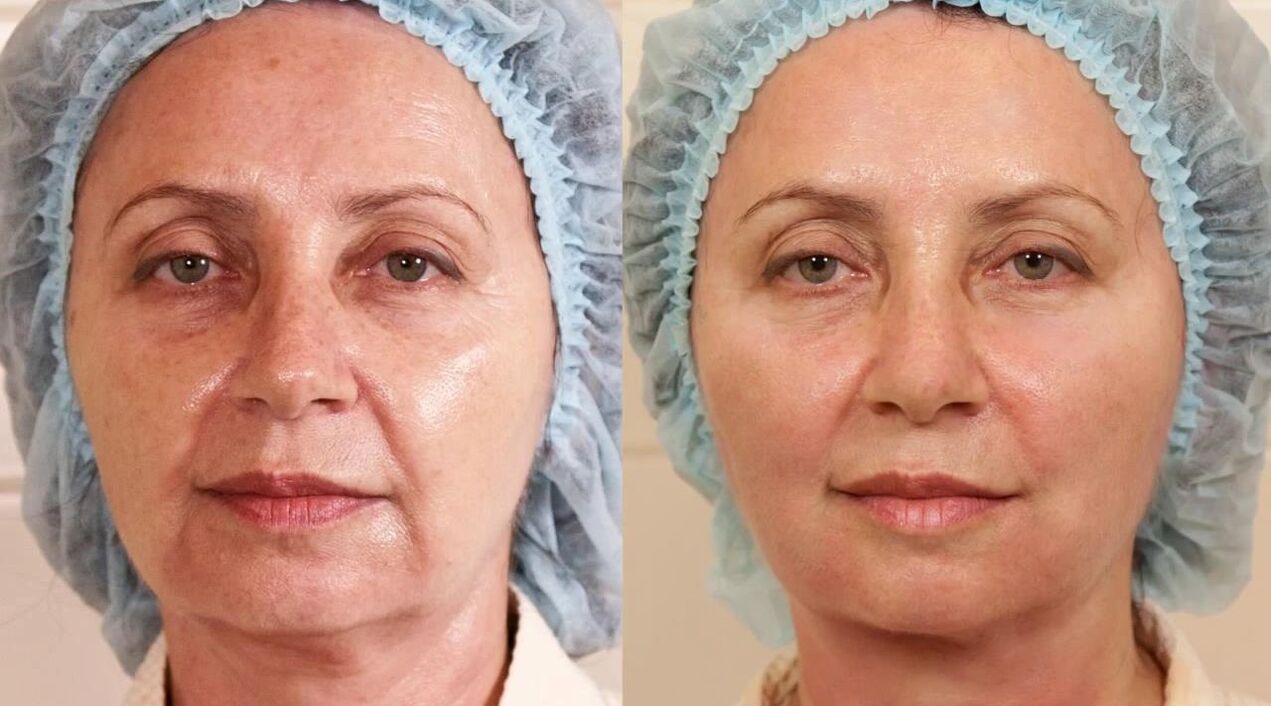før og efter billeder af ansigtsløftning