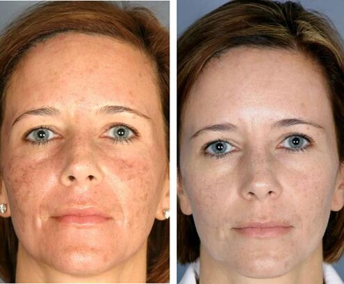 Før og efter fraktioneret ansigts-termolyse