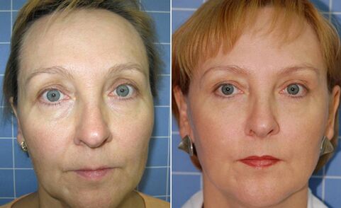 Før og efter fraktioneret laser ansigtsforyngelse