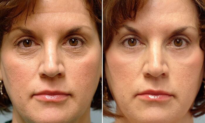 ansigt før og efter laserfraktioneret foryngelse